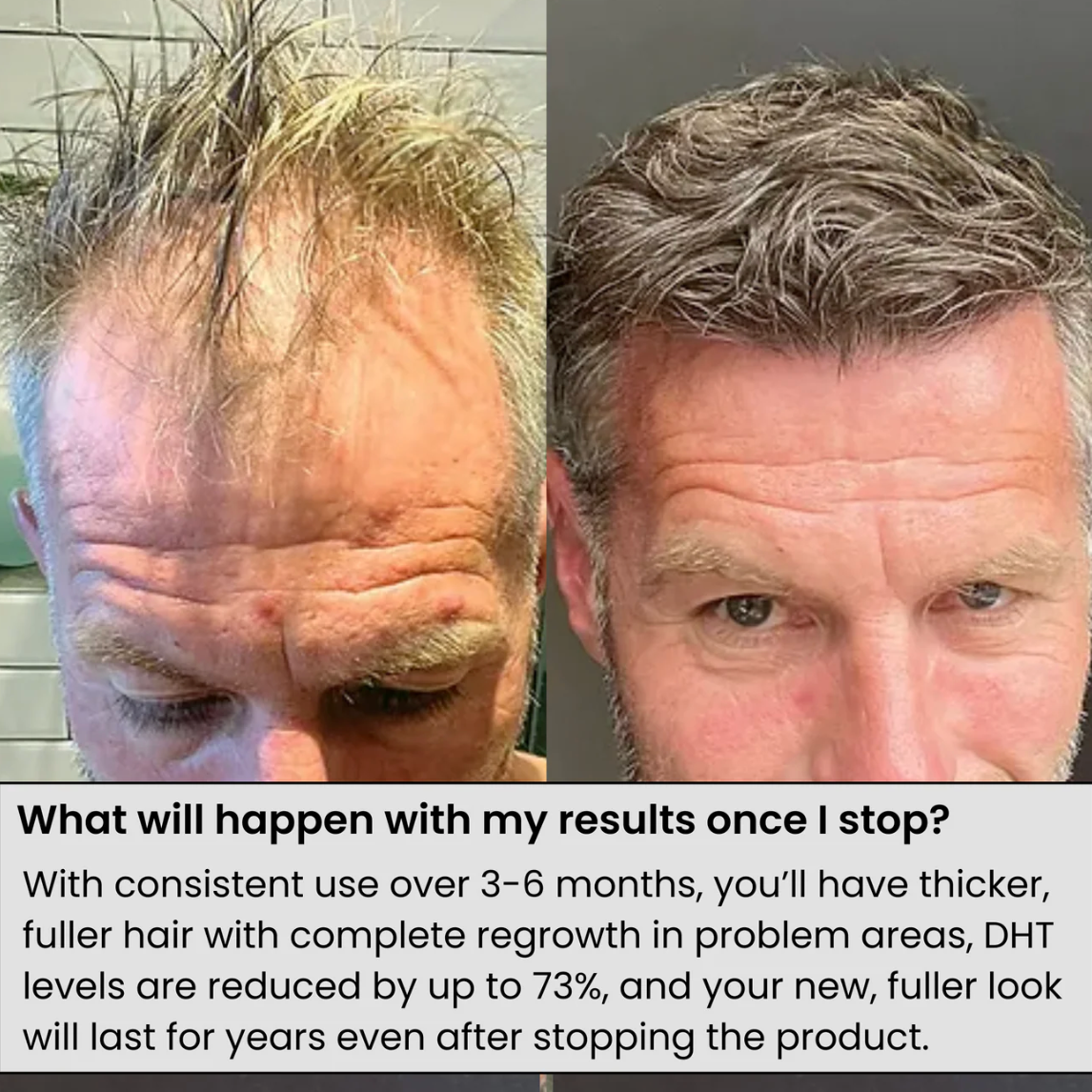 VOLTORA™ HAIR Regrowth Serum