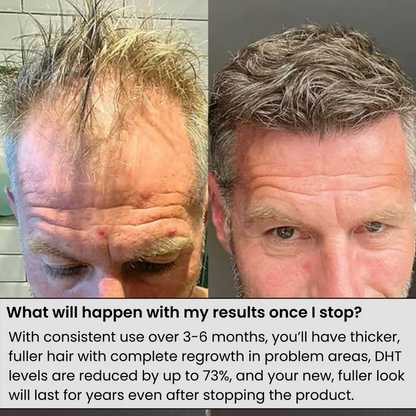 VOLTORA™ HAIR Regrowth Serum